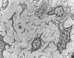 M,49y. | advanced glomerulosclerosis M,49y. | advanced glomerulosclerosis